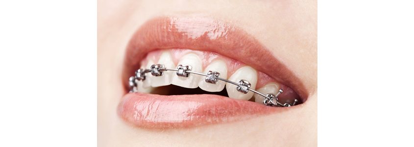 adult orthodontics