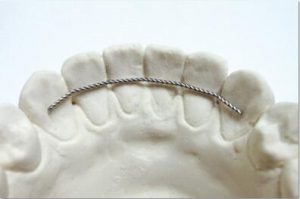 banded lingual retainer