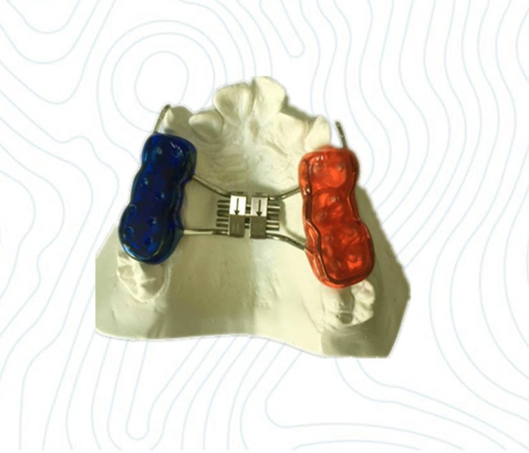 bondedrapidpalatalexpander1 China Orthodontic