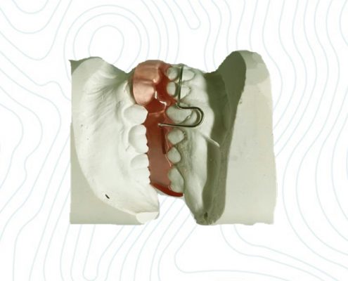 orthodontic bionator appliance