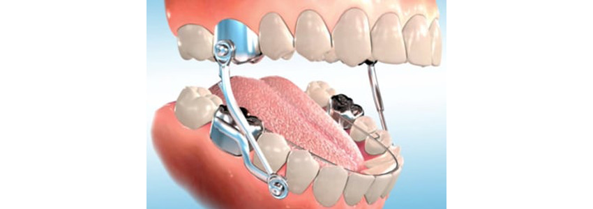 orthodontic herbst appliance