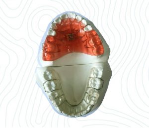 orthodontic schwartz appliance