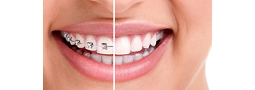 orthodontic treatment