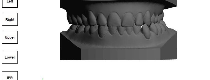 clear aligner treatment plan