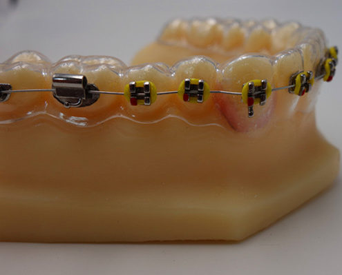 clear retainer with brackets