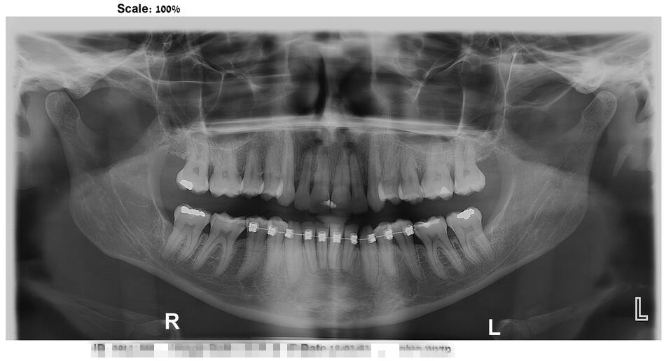 How we make Clear Aligner works? | China Orthodontic