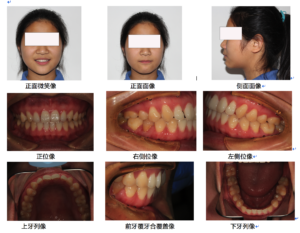 clear aligner picture